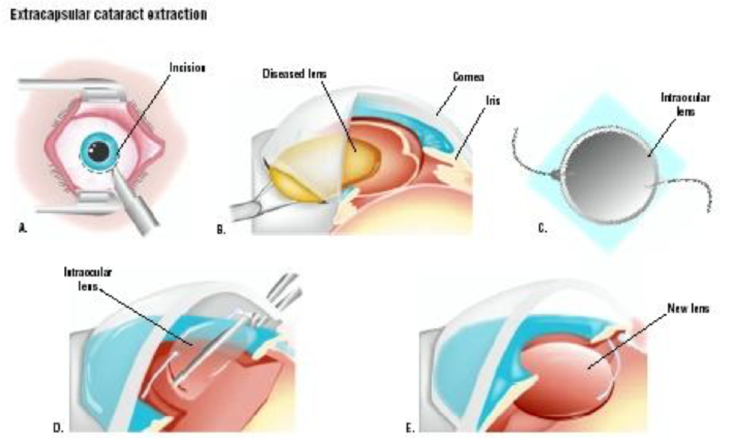 What is cataract surgery?
